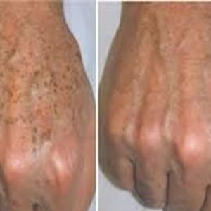 peeling-facial-ejemplo3